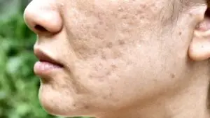 Tampilan tekstur kulit dengan atrophic scars untuk menjelaskan apakah bopeng bisa hilang secara medis.