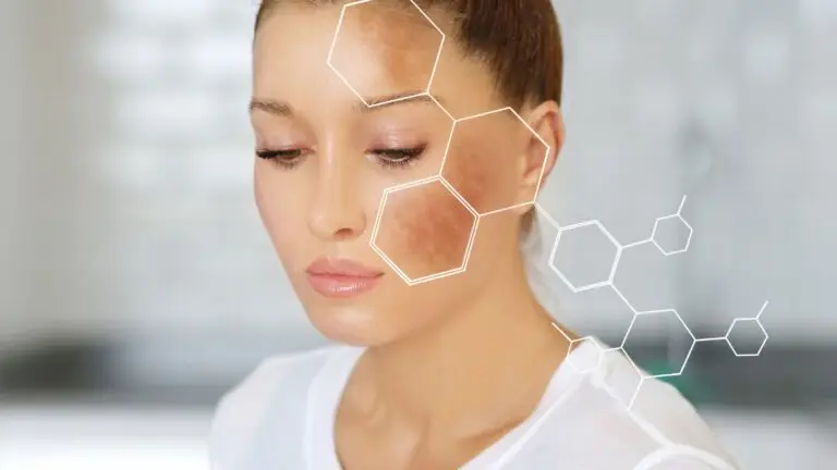 wanita dengan gejala melasma